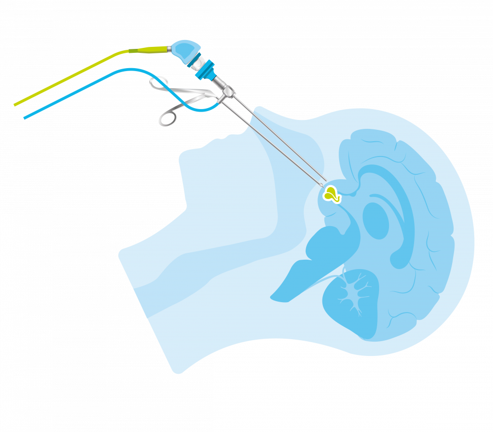 Endoscopische operatie van een hypofysetumor